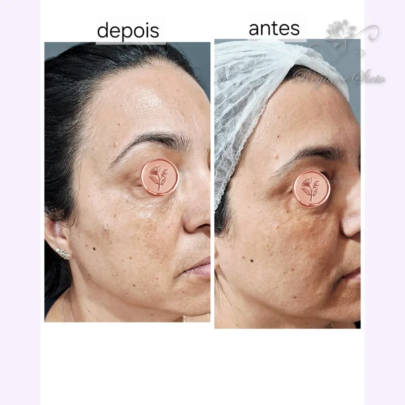 Antes e depois de Bioestimuladores de Colágeno — clínica Regiane Sieto, Ribeirão Preto