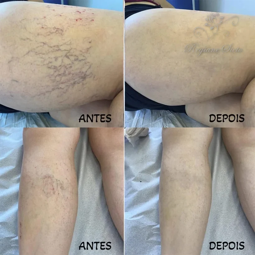 Antes e depois de Escleroterapia — clínica Regiane Sieto, Ribeirão Preto