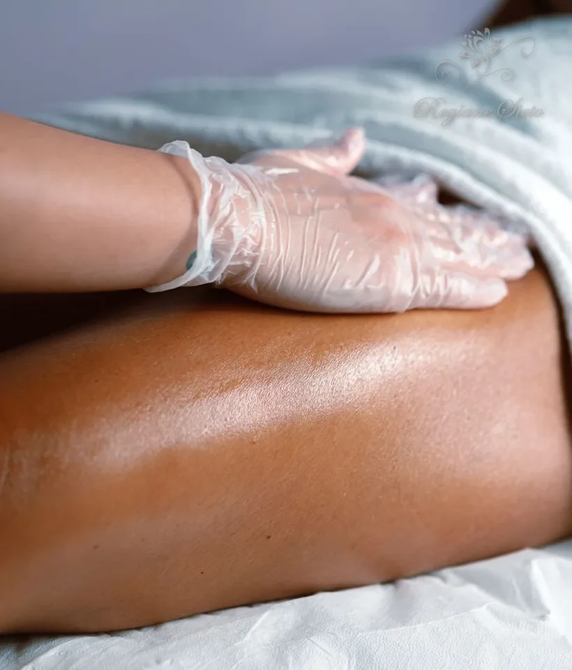 Escleroterapia em Ribeirão Preto — Regiane Sieto