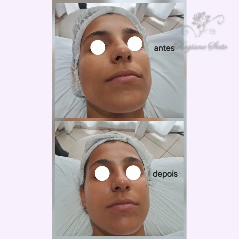 Antes e depois de Limpeza de Pele — clínica Regiane Sieto, Ribeirão Preto