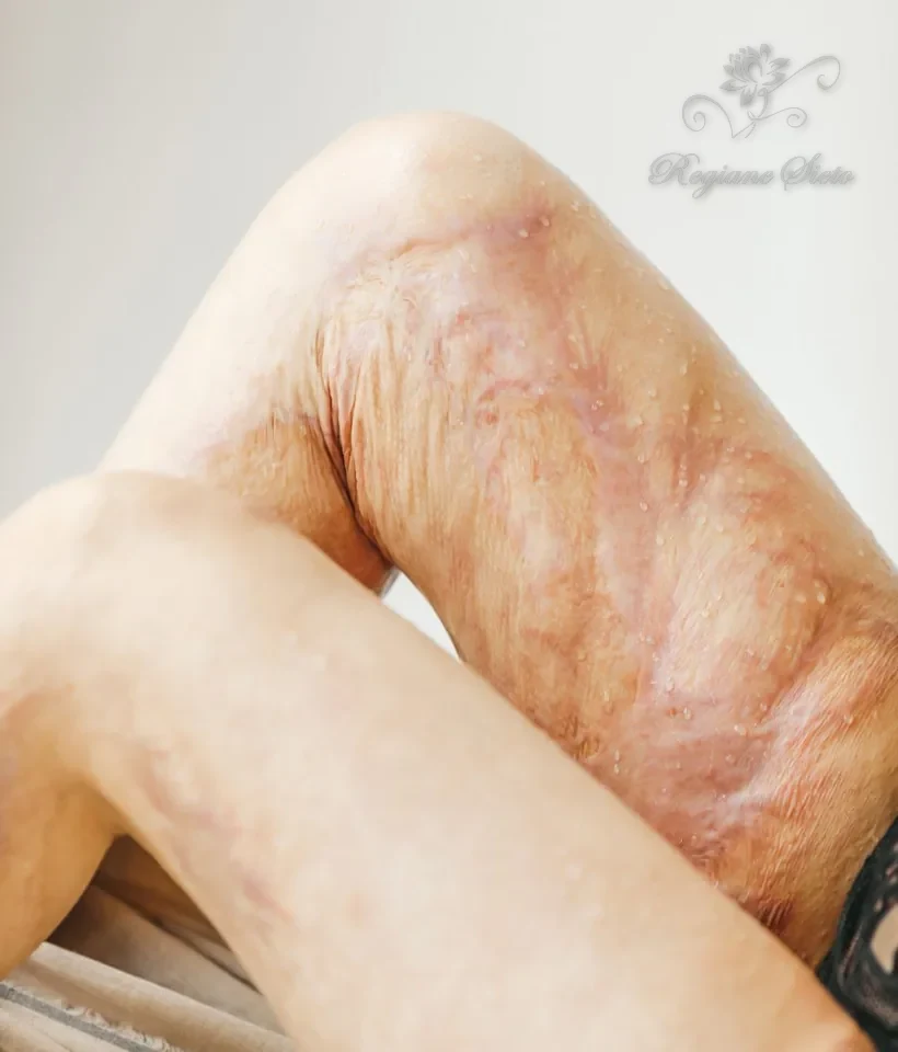 Protocolo para Lipedema em Ribeirão Preto — Regiane Sieto