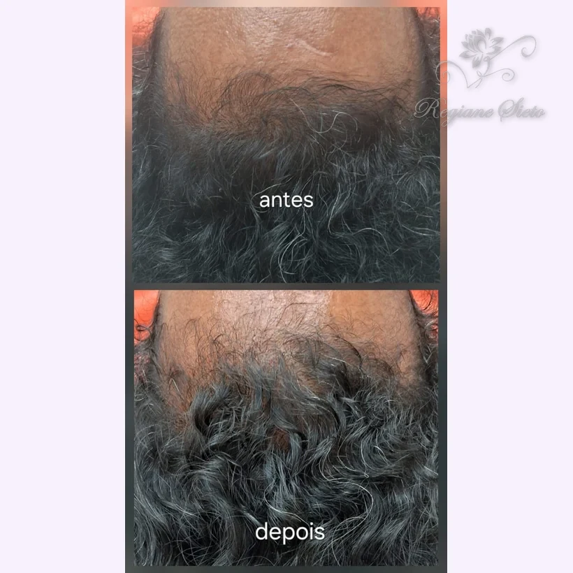 Antes e depois de Tratamento Capilar — Mesoterapia — clínica Regiane Sieto, Ribeirão Preto