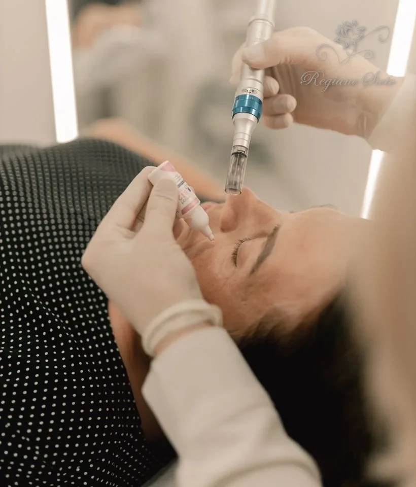 Microagulhamento Facial em Ribeirão Preto — Regiane Sieto