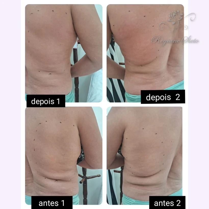 Antes e depois de Radiofrequência Corporal — clínica Regiane Sieto, Ribeirão Preto